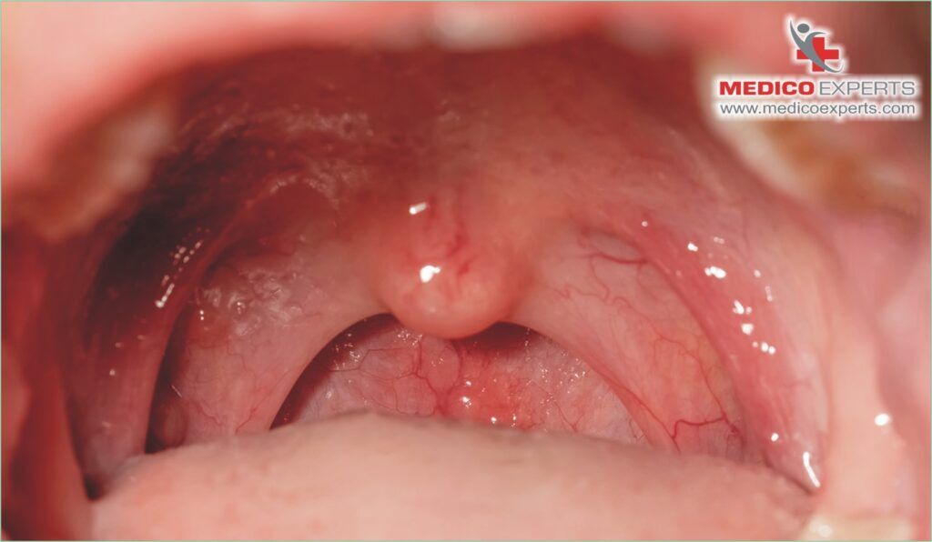 how fast can you get mouth cancer from chewing tobacco Pathologic Manifestations of Smokeless How to Check for Mouth