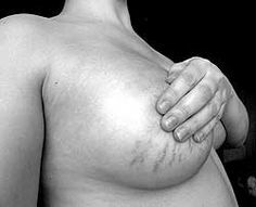 10 Poor Breast Changes After Pregnancy and Breastfeeding