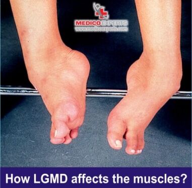 What is Limb Girdle Muscular Dystrophy (and how does it affect me
